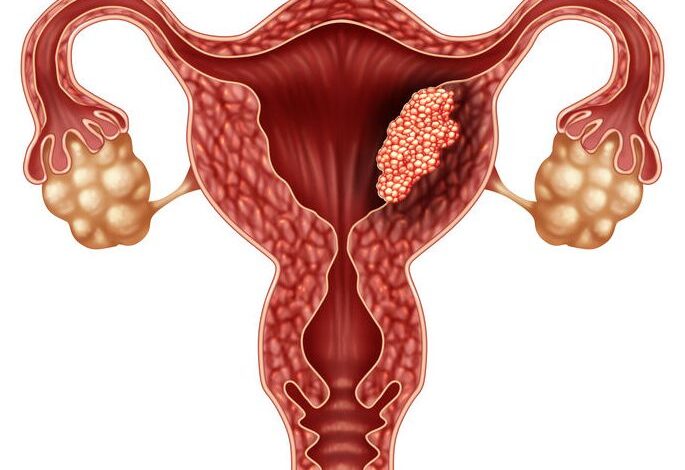 GSK presenta nueva alternativa terapéutica para cáncer de endometrio en México