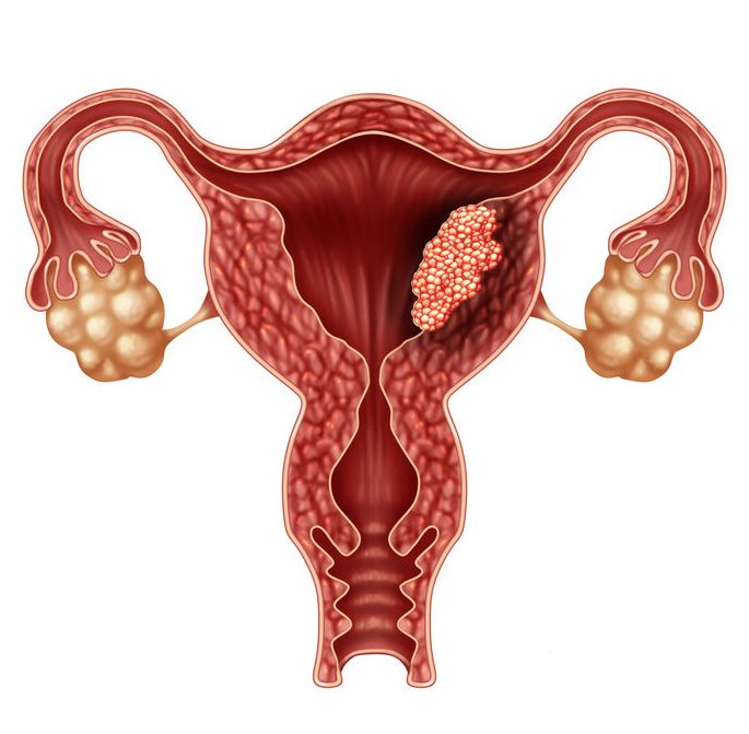 GSK presenta nueva alternativa terapéutica para cáncer de endometrio en México
