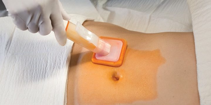 Sepsis: prevenir puede salvar vidas