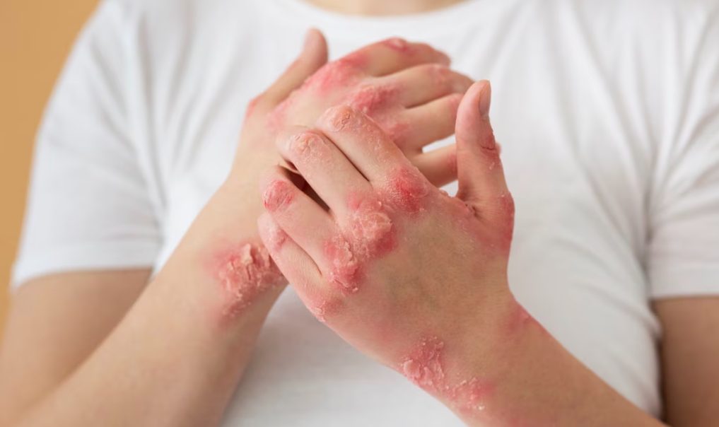 Psoriasis y salud mental: la depresión puede afectar hasta al 62% de quienes viven con esta enfermedad